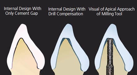 Tooth Preparation Considerations for CAD/CAM Materials in