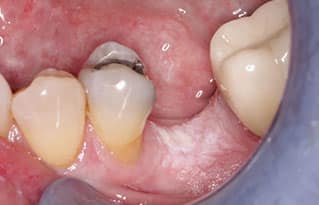 frictional keratosis gums