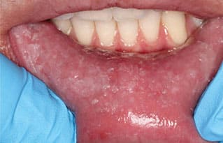 frictional keratosis cheek