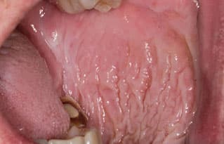 frictional keratosis cheek