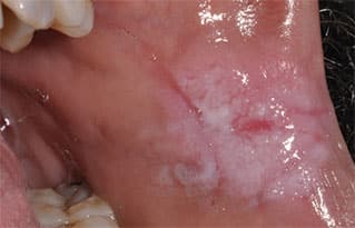 frictional keratosis cheek