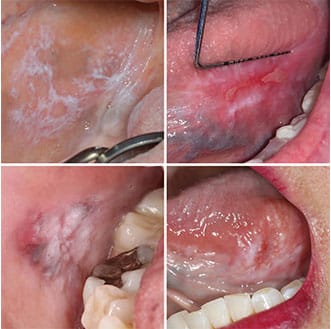 frictional keratosis cheek