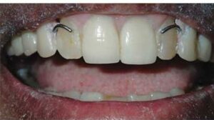 removable partial denture