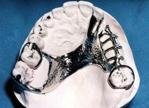 A removable partial denture