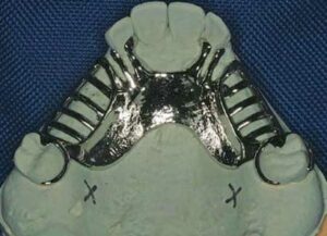 Removable partial denture