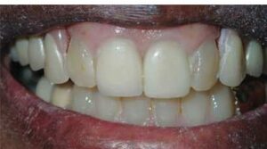 Removable partial denture