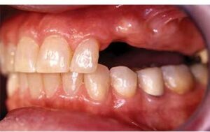 A partially edentulous patient