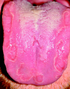 Geographic tongue affecting the dorsal surface