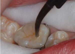 Apply one drop of water to displace the moisture from the narrow fissures.