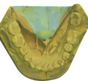 Scanned mandibular cast