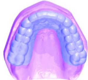 Occlusal appliance shell