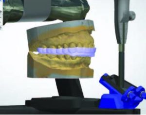 Occlusal cast