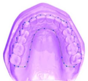 Occlusal model 