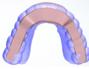 Occlusal with shell bar