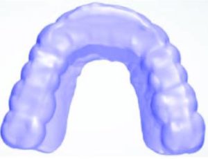 A completed occlusal appliance