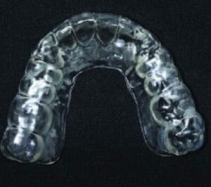 Occlusal view of the printed occlusal splint