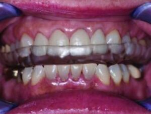 Occlusal appliance