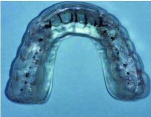 Occlusal splint