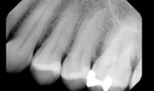 Periapical radiograph