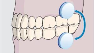 Oral adhering disc placement