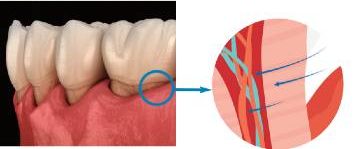 Dentinal hypersensitivitygraphic