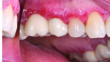 erosive lichen planus gingiva