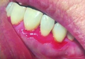 Mucous membrane