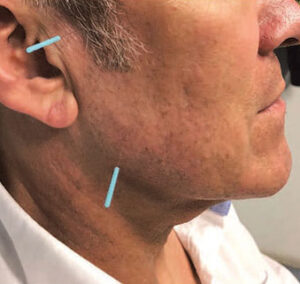 Man with acupuncture needles for facial pain.