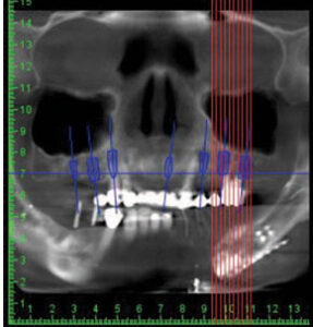 Presurgical planning for implant 