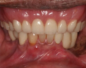 Immediate complete denture