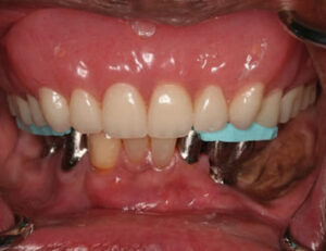 Try-in for mandibular restorations