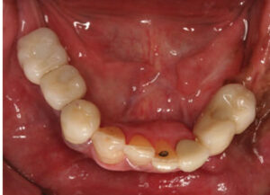 Final mandibular implant