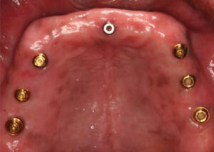 Implant-supported overdenture