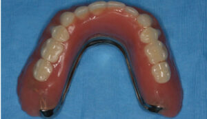 Maxillary implant-supported overdenture, occlusal view.