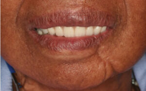 Final smile over implant-supported overdenture patient.