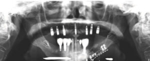 Final view of implant-supported overdenture patient