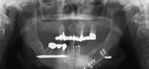 X-ray of implant-supported overdenture patient