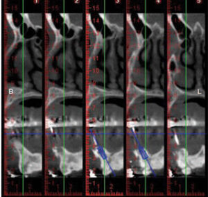 Implant placement procedure