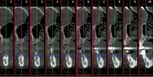 Planning for implant placement procedure