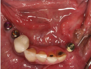 Mandibular implant placement