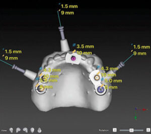 Presurgical planning site