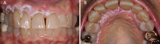 Oral white lesions