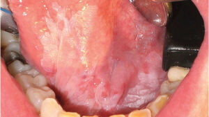 Oral white lesion