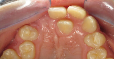 Orofacial cleft