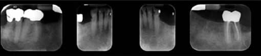 Radiograph of mandibular arch