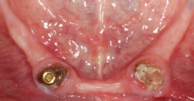 Preoperative occlusal view of a dental implant