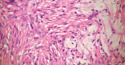 Image of intrabony xanthoma, a benign lesion.