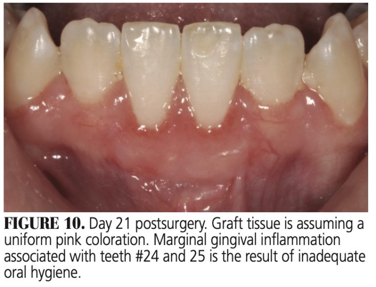 Healing Progression of the Free Gingival Graft Decisions in Dentistry