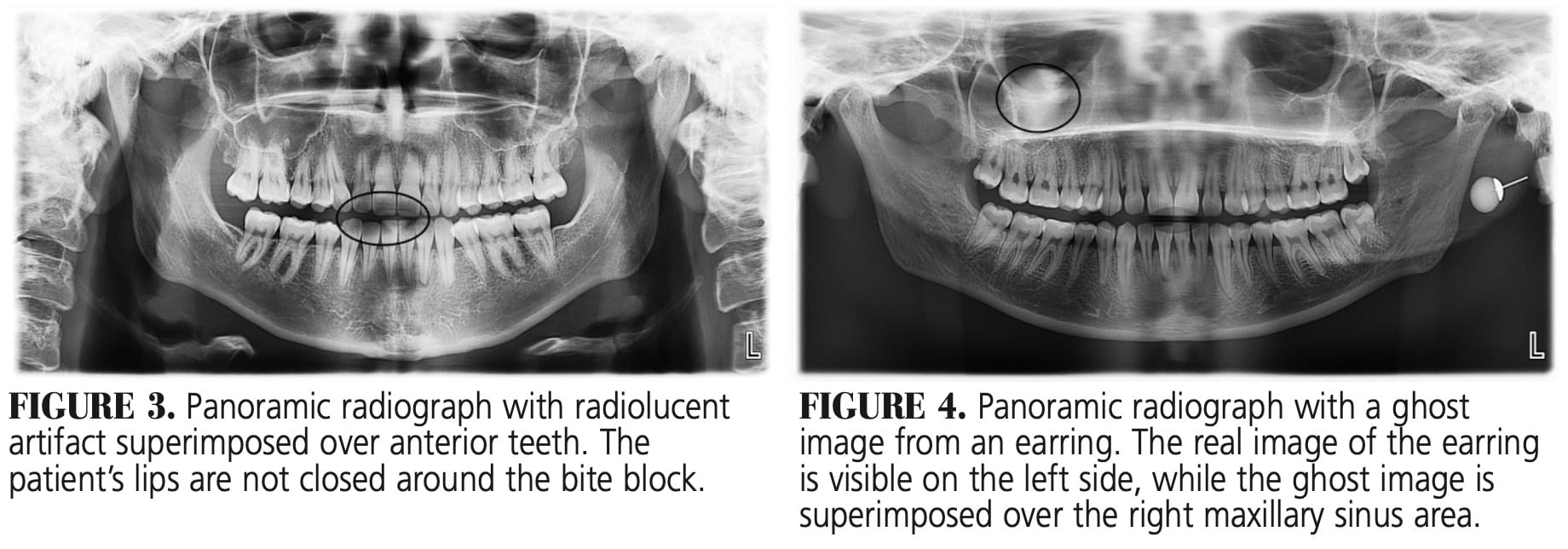 Optimal Panorex Imaging - Decisions in Dentistry