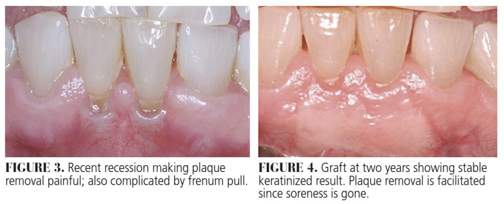 palatal figure